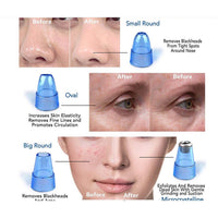 4 in 1 blackhead remover product image 3